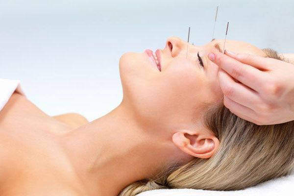 acupunctura